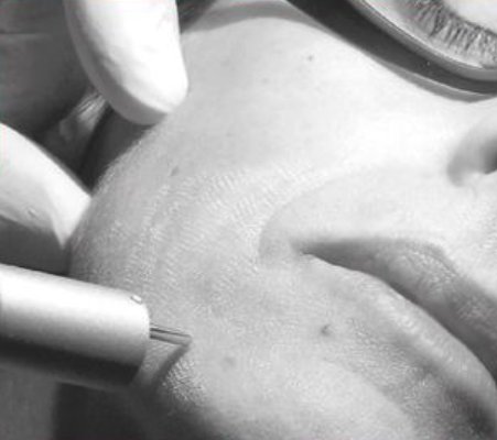 pluser Er:YAG Laser Aesthetics Use_feat